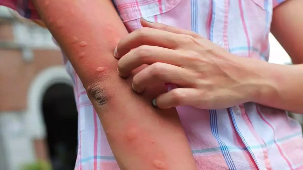 Es ist weder eine Mücke noch eine Wespe: Dieses Tier hat den schmerzhaftesten Stich des Sommers – wie man es erkennt und sich davor schützt.
